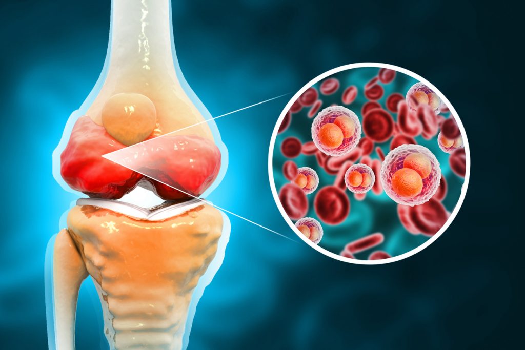 Knee injury. Platelet Rich Plasma for Knee Osteoarthritis. 3d illustration