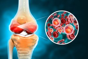 Knee injury. Platelet Rich Plasma for Knee Osteoarthritis. 3d illustration