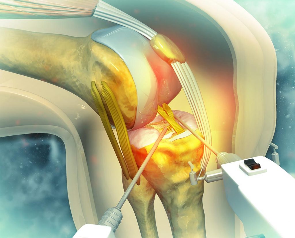 Cirurgia artroscòpica
