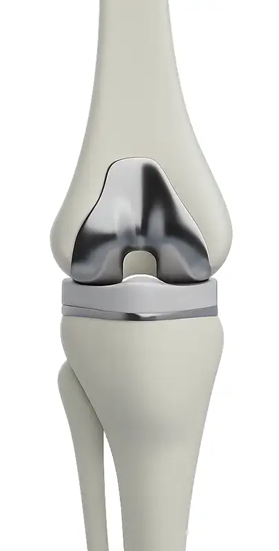 1.Imatge protesi de genoll blanc2